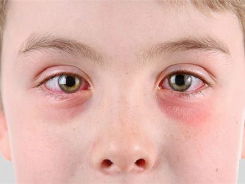 Mắt bị sưng mí dưới – Nguyên nhân và cách điều trị tốt nhất