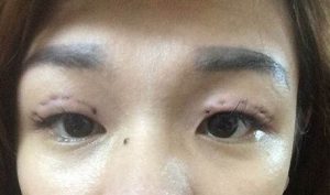 tác hại của việc nhấn mí mắt 3