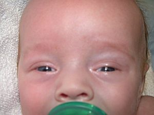 trẻ sơ sinh bị sưng mí mắt 1