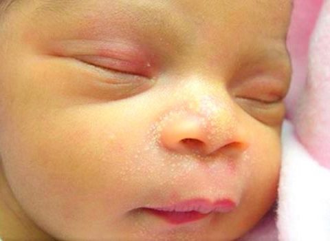 Lý do trẻ sơ sinh bị sưng mí mắt – Cách phòng tránh và điều trị
