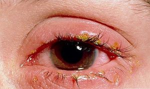 cách chữa viêm mí mắt 2