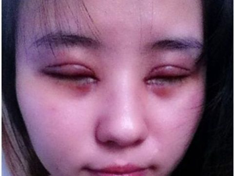 Mí mắt bị sưng và nhức sau cắt mí – cách xử lý