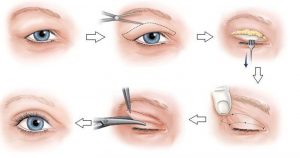 Minh chứng chứng minh cắt mí mắt có ảnh hưởng gì không 1
