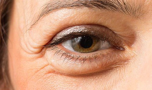 Nguyên nhân và cách chữa sưng bọng mắt dưới 2