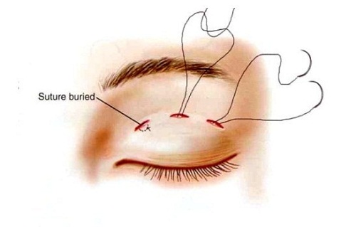 Cách làm tan máu bầm ở mí mắt sau khi bấm mí mắt 1