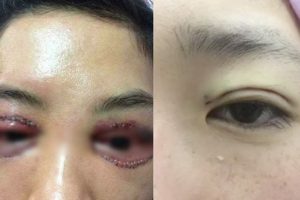 Từ A đến Z về tác hại của cắt mí mắt cần biết 1