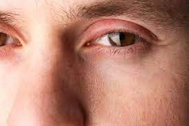 Nguyên nhân mí mắt bị ngứa và sưng 1