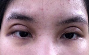 Những tác hại của việc nhấn mí mắt có thể gặp phải, nguyên nhân và phòng tránh 2