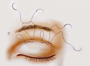 Những trường hợp có tình trạng mắt 1 mí nam như sau thì nên bấm mí: Những trường hợp có tình trạng mắt 1 mí nam trong khoảng độ tuổi trên 18 đến dưới 30, mắt không có sự tồn tại của da thừa (nếp nhăn), mỡ thừa thì nên bấm mí. 2