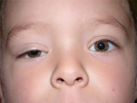 Nguyên nhân sụp mí mắt 1 bên – Cách điều trị