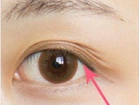 Thông tin và cách điều trị: Mí mắt có nhiều nếp gấp