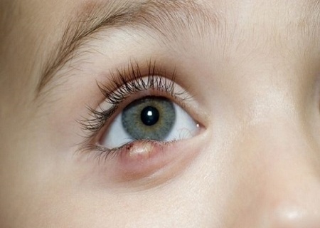 Nổi hạt trắng ở mí mắt dưới là bệnh gì? Cách phòng bệnh