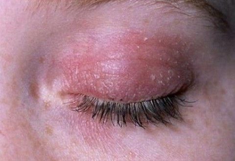 Nguyên nhân và cách điều trị viêm mí mắt trên
