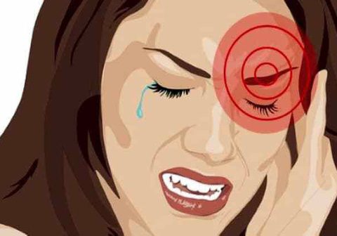 Tại sao bị nhức mắt trái – Hướng dẫn cách chữa