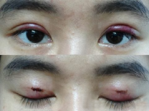 Cách giảm sưng đau mí mắt trên sau cắt mí